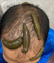Leech Therapy in Ayurveda (With Photos), A Definitive Guide – Ayurvedic  Clinic in Pune | Vishwamukta Ayurved