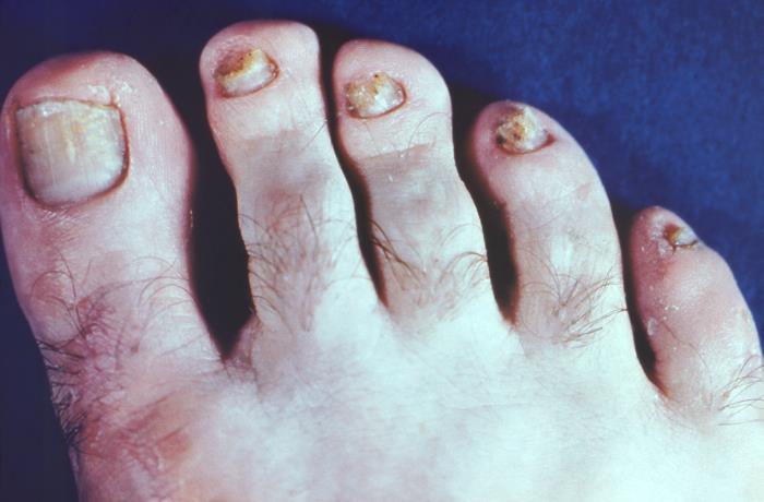 ayurveda foot nail gombák)