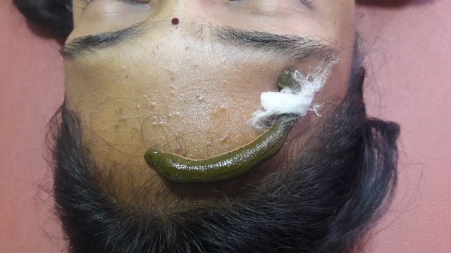 Leech Therapy In Ayurveda