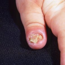 Ayurveda Treatment for Nail Fungus Infection