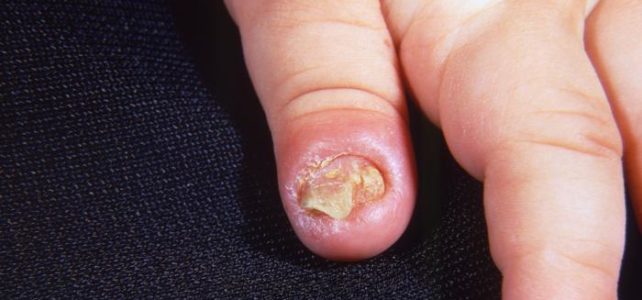 Ayurveda Treatment for Nail Fungus Infection