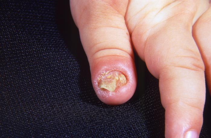 Fungal Nail Infection Damage On Human Stock Photo 702668947 | Shutterstock