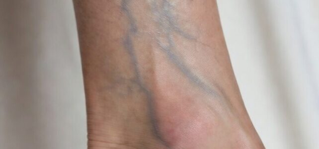 Ayurveda Treatment For Varicose Veins
